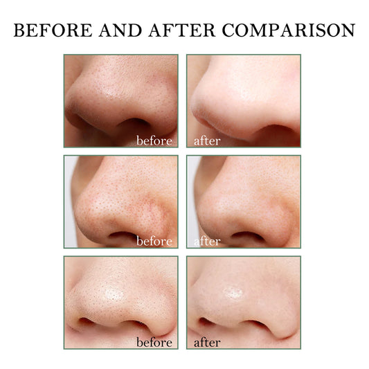 Before and after comparison of a nose treatment on a white background